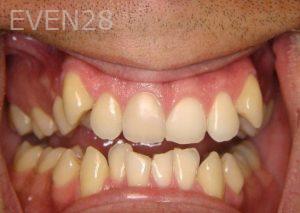 Ernest-Wong-Orthodontic-Braces-before-1