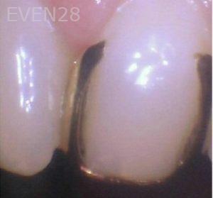 George-Bovili-Dental-Crowns-before-2