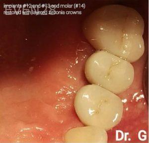 George-Bovili-Dental-Implants-after-3b