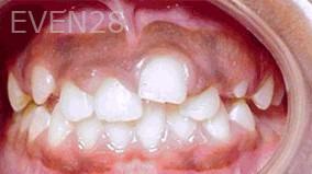 George-Tashiro-Orthodontic-Braces-before-4