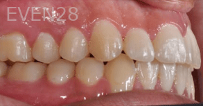 Hang-Pham-Orthodontic-Braces-after-1c