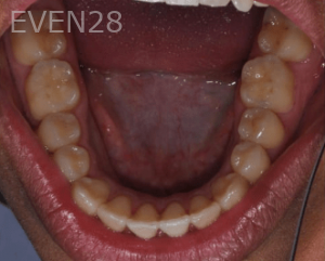 Hang-Pham-Orthodontic-Braces-after-2b