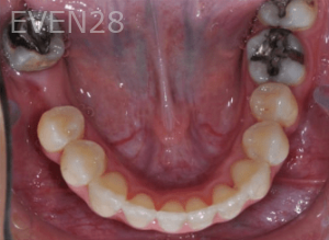 Hang-Pham-Orthodontic-Braces-after-3b