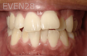 Hang-Pham-Orthodontic-Braces-before-1