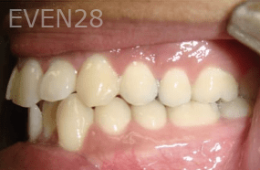 Hang-Pham-Orthodontic-Braces-before-1b
