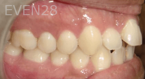 Hang-Pham-Orthodontic-Braces-before-1c