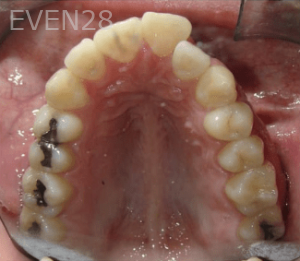 Hang-Pham-Orthodontic-Braces-before-2