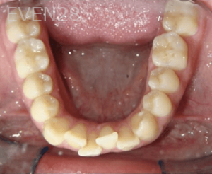 Hang-Pham-Orthodontic-Braces-before-2b