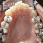 Hang-Pham-Orthodontic-Braces-before-3