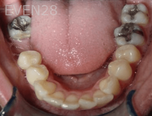 Hang-Pham-Orthodontic-Braces-before-3b