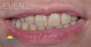 Hang-Pham-Teeth-Whitening-before-3