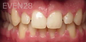 Hang-Pham-Teeth-Whitening-before-4