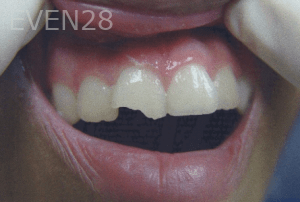 Huy-Dang-Dental-Bonding-before-1