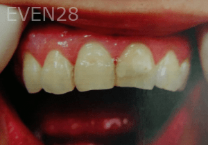 Huy-Dang-Dental-Crowns-before-1