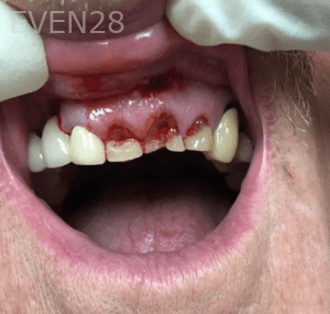 Huy-Dang-Dental-Crowns-before-3
