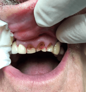 Huy-Dang-Dental-Crowns-before-3b
