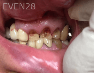 Huy-Dang-Dental-Crowns-before-3c