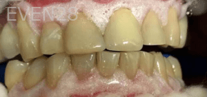 Huy-Dang-Teeth-Whitening-before-1