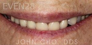 John-Cho-Dental-Crowns-before-1