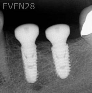 John-Cho-Dental-Implants-after-2