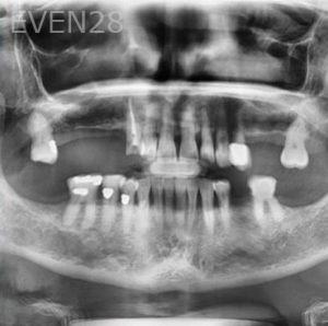 John-Cho-Full-Mouth-Dental-Implants-before-1b