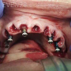 John-Cho-Full-Mouth-Dental-Implants-before-1c