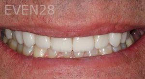 John-Cho-Porcelain-Veneers-after-1