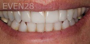 John-Cho-Porcelain-Veneers-after-2