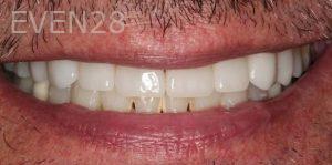 John-Cho-Porcelain-Veneers-after-3