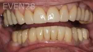 John-Cho-Porcelain-Veneers-after-4