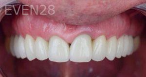 John-Cho-Porcelain-Veneers-after-5