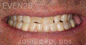 John-Cho-Porcelain-Veneers-before-1