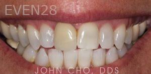 John-Cho-Porcelain-Veneers-before-2