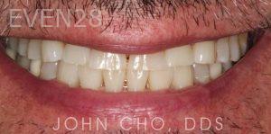 John-Cho-Porcelain-Veneers-before-3