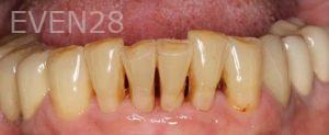 John-Cho-Porcelain-Veneers-before-4