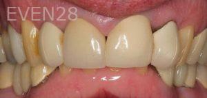 John-Cho-Porcelain-Veneers-before-5