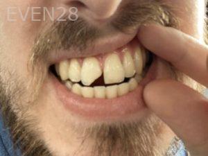 John-Czochanski-Dental-Bonding-before-1