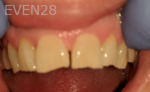 Johnny-Nigoghosian-Dental-Crown-before-2