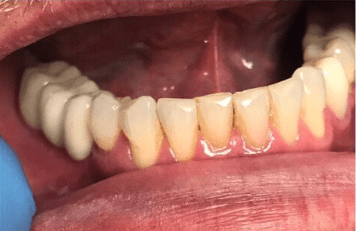 Johnnu-Nigoghosian-Dental-Implants-after-12