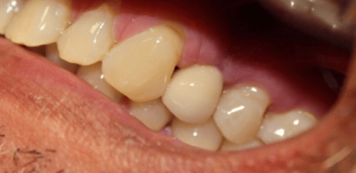 Johnnu-Nigoghosian-Dental-Implants-after-13-1