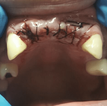 Johnnu-Nigoghosian-Dental-Implants-after-18-1