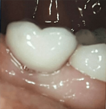 Johnnu-Nigoghosian-Dental-Implants-after-20
