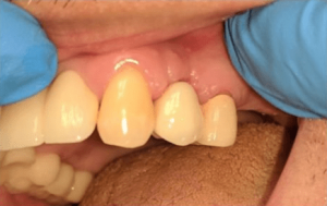 Johnny-Nigoghosian-Dental-Implants-after-5