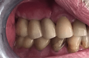 Johnny-Nigoghosian-Dental-Implants-after-7