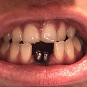 Johnnu-Nigoghosian-Dental-Implants-before-10