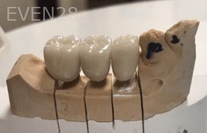 Johnny-Nigoghosian-Dental-Implants-before-12b-1
