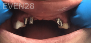 Johnny-Nigoghosian-Dental-Implants-before-16-1