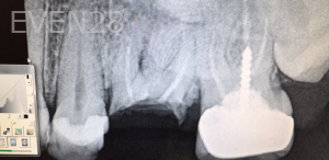Johnny-Nigoghosian-Dental-Implants-before-17-1