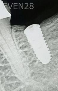 Johnny-Nigoghosian-Dental-Implants-before-20b