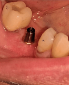 Johnnu-Nigoghosian-Dental-Implants-before-3